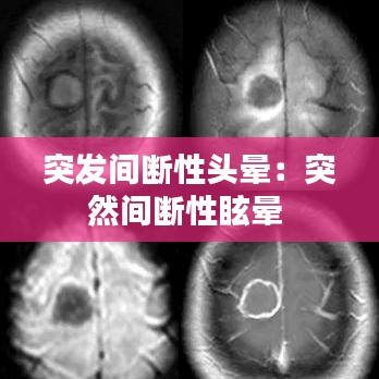 突发间断性头晕：突然间断性眩晕 