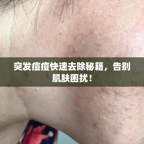 突发痘痘快速去除秘籍，告别肌肤困扰！